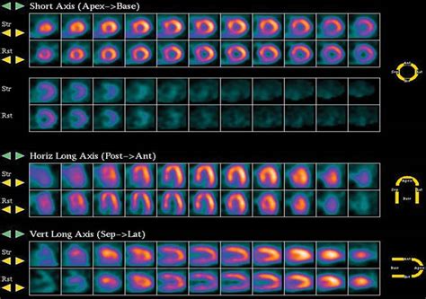 35 Diaphragmatic Attenuation Artifact | Radiology Key