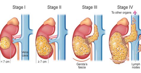 Stages of Kidney Cancer Treatment - Dr. Irfan Shaikh | Urolife Clinic, Pune