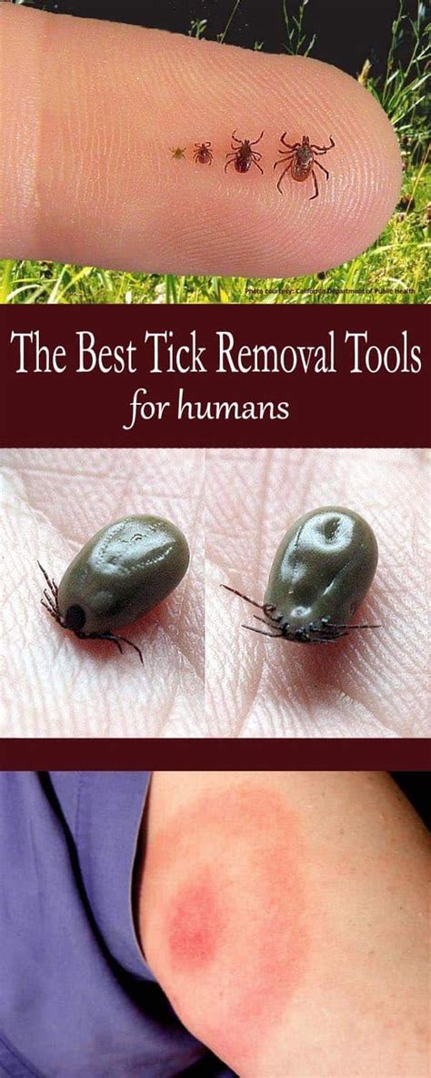 The Best Tick Removal Tools for Humans - Mom Goes Camping in 2020 | Tick removal, Remove ticks ...