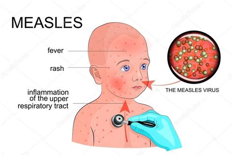 South West Voice - Measles alert: infectious man visits Mt Annan ...