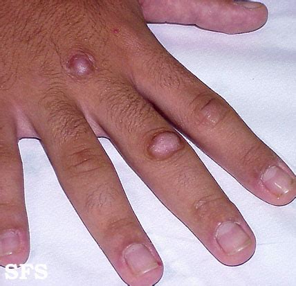 Knuckle Pain on Hand (Painful Finger Joints) Causes and Treatment ...