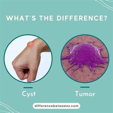 Difference between Cyst and Tumor | Cyst vs Tumor