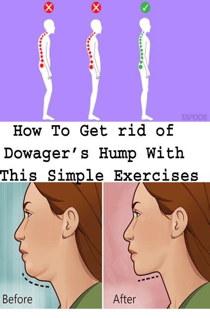 How To Get rid of Dowager’s Hump With This Simple Exercises? | healhty life style | Easy ...