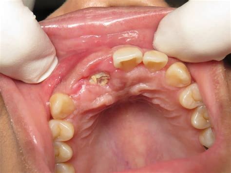 Complication - Bone Graft is Exposed – Platelet PRF Treatment