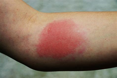 Insect sting allergy - myDr.com.au