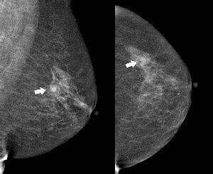 Focal asymmetry representing malignancy. (a) MLO views and (b) CC views... | Download Scientific ...