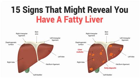 Liver issues - tronicspoliz