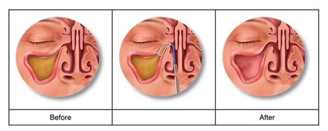 Want Lasting Sinus Pain Relief? | Balloon Sinuplasty