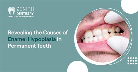 Revealing the Causes of Enamel Hypoplasia in Permanent Teeth | Zenith Dentistry