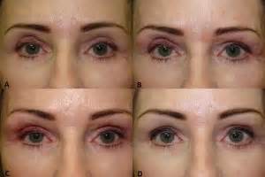 Upper Eyelid Hollows or Sunken Eyelids after Blepharoplasty Surgery – Eyelid Fillers Can Be The ...