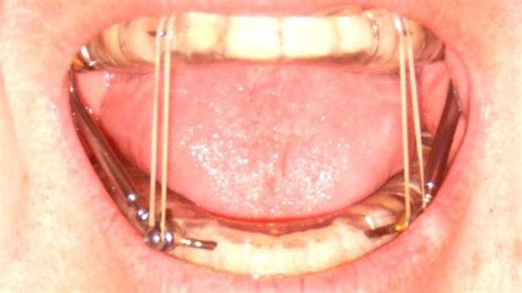 Mandibular advancement splint