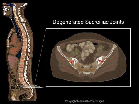 Color CAT Scan Medical Image showing degenerated Sacroiliac Joints. Ideal for Medical Websites ...