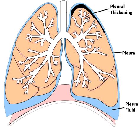 pleural-thickening-lungs | Mesothelioma Treatment Centers