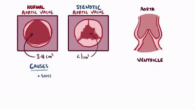 Aortic valve disease (bicuspid, tricuspid) - stenosis, regurgitation, symptoms on Make a GIF