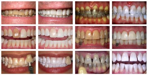 Collegeville KöR Whitening System Dentist | Advanced Dentistry