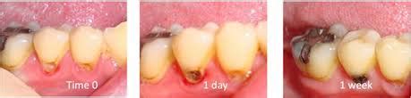 Silver Diamine Fluoride in Dunedin FL - Preventing Tooth Decay