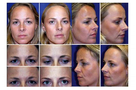 Preventative Botox Twins Study: Botox in Your 20’s and 30’s - Smooth ...