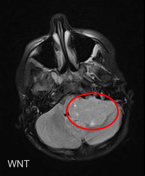 Medulloblastoma | Pediatric Brain Tumor Portal