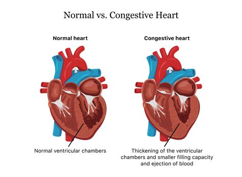 Aetiology and Pathophysiology of Heart Failure - Get Essay Writing Help at $10/Page