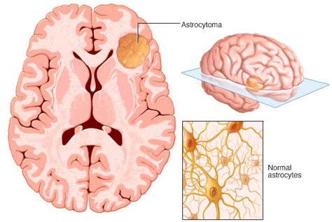 Astrocytoma | Expert Surgeon | Aaron Cohen-Gadol, MD