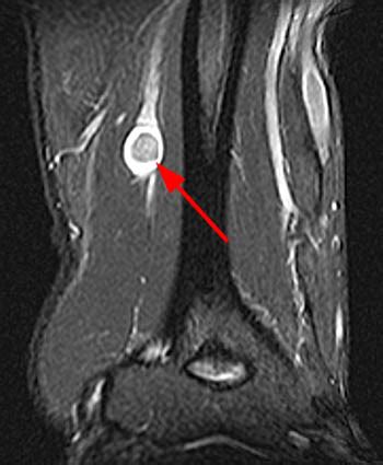 Schwannoma of the Median Nerve | Radsource