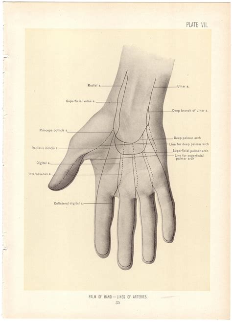 1899 Antique PALM OF HAND Surgical Anatomy Illustration