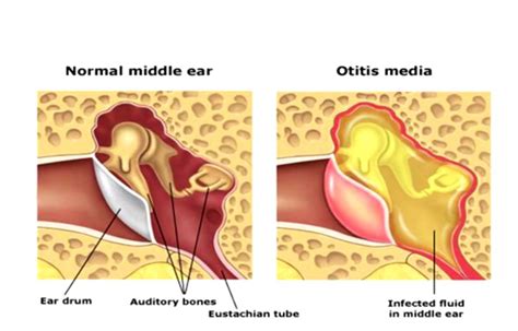 Middle Ear Infection - Cure For Otitis Media