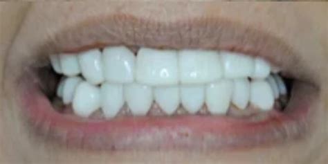 Press On Veneers Before and After - Photo Gallery – TruSmile Veneers