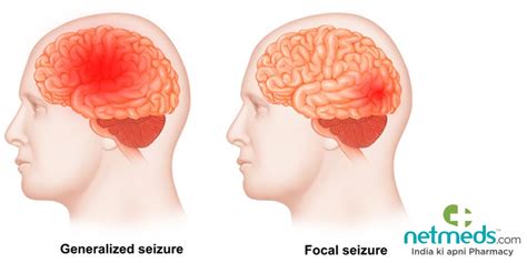 Focal Onset Seizures/Partial Seizures: Causes, Symptoms And Treatment