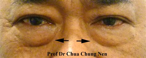 Eyelid Surgery by Prof Dr CN CHUA 蔡鐘能: March 2013