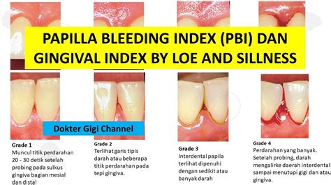 Part 2| Pemeriksaan Papilla Bleeding Index PBI by Muhlemann dan ...