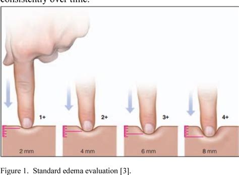 AERO: An Objective Peripheral Edema Measurement Device | Semantic Scholar