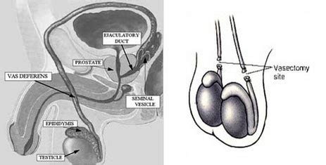 Vasectomy Reversal - Institute for Reproductive Health