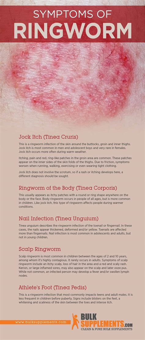 Tablo | Read 'Ringworm: Symptoms, Causes & Treatment' by
