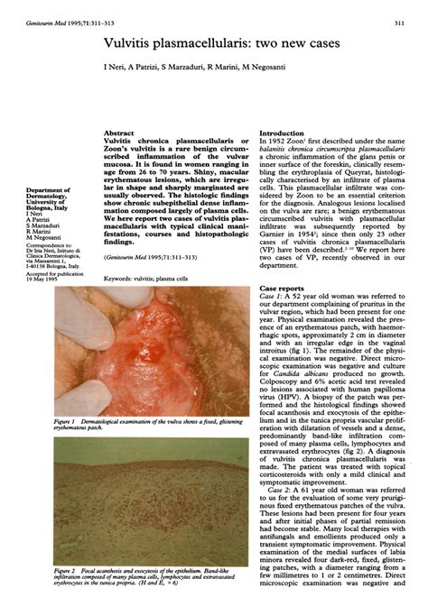 (PDF) Vulvitis plasmacellularis: Two new cases