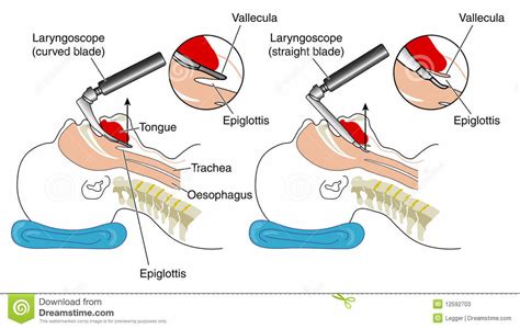 History of the Laryngoscope