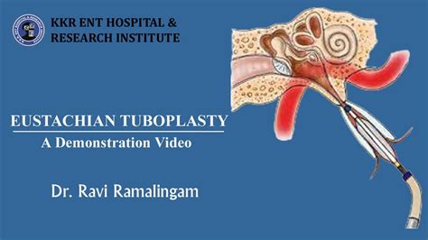 EUSTACHIAN TUBOPLASTY | EUSTACHIAN TUBE DYSFUNCTION I EAR BLOCK I RETRACTED EARDRUM I KKR ENT I ...