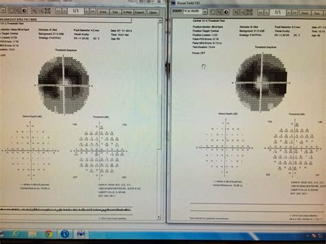 Plaquenil Retinopathy Screening Requirements: Are You Up to Date on the New Standards? - Eyedolatry