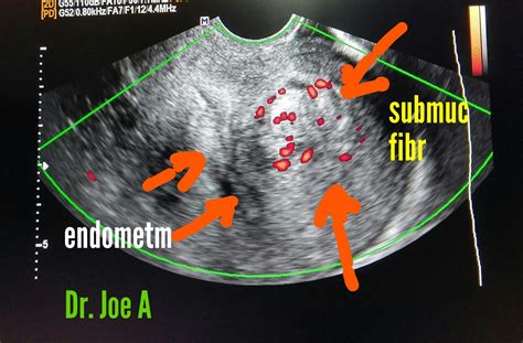 Ultrasound imaging: Submucosal-fibroid-vascular