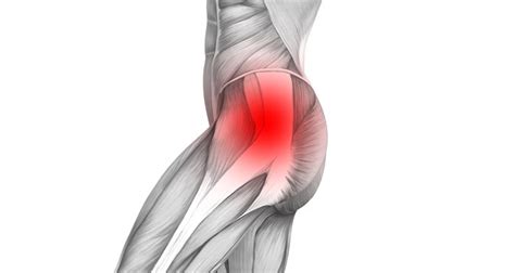 Hip Synovitis - Symptoms, Causes, Treatment & Rehabilitation