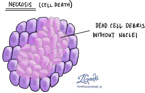 Necrosis - Pathology dictionary - MyPathologyReport.ca