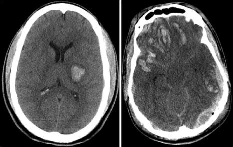 Contusion Cerebral