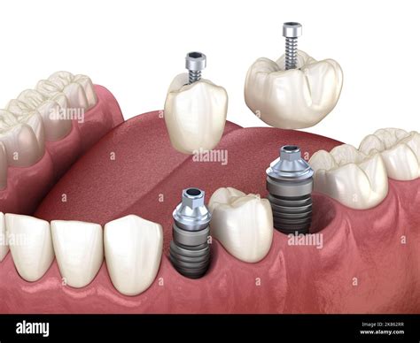 Premolar and Molar tooth crown installation over implant, screw fixation. 3D illustration of ...