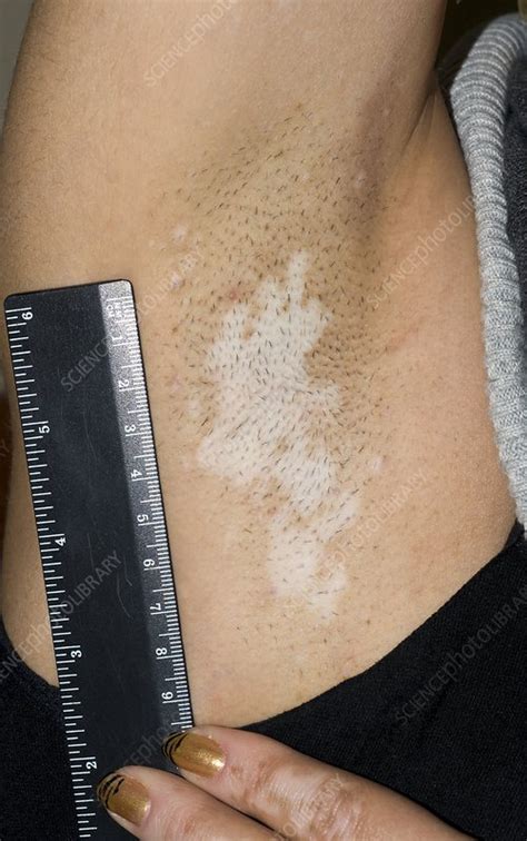 Vitiligo of the underarm - Stock Image - C001/8637 - Science Photo Library