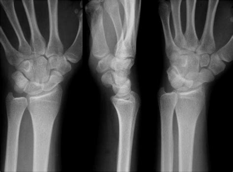 How to Read Wrist Xrays - Ortho Conditioning