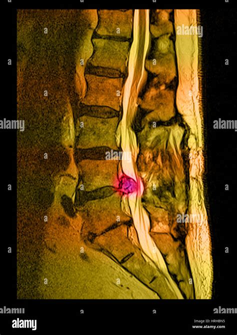 Herniated lumbar disc mri hi-res stock photography and images - Alamy