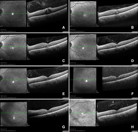 These images represent OCT images of the macula during the first week ...