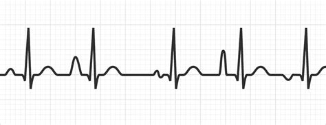 Premature Atrial Contraction Strip