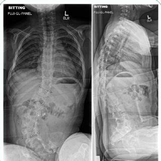 2 view Spine films demonstrating a dextroconvex curvature of the... | Download Scientific Diagram