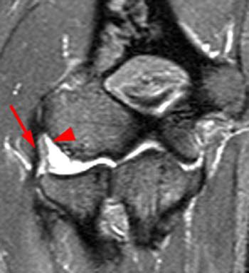 Radial Lateral Ligament Tear